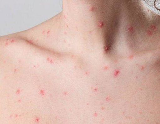 Lee más sobre el artículo CONFIRMAN NUEVO CASO DE VIRUELA SÍMICA EN QUERÉTARO