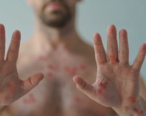 Lee más sobre el artículo CONTINÚA VIGILANCIA EPIDEMIOLÓGICA POR VIRUELA SÍMICA