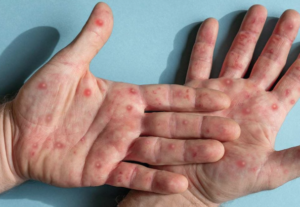 Lee más sobre el artículo CONTINÚA SESA VIGILANCIA EPIDEMIOLÓGICA DE VIRUELA SÍMICA