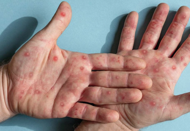 Lee más sobre el artículo CONTINÚA SESA VIGILANCIA EPIDEMIOLÓGICA DE VIRUELA SÍMICA