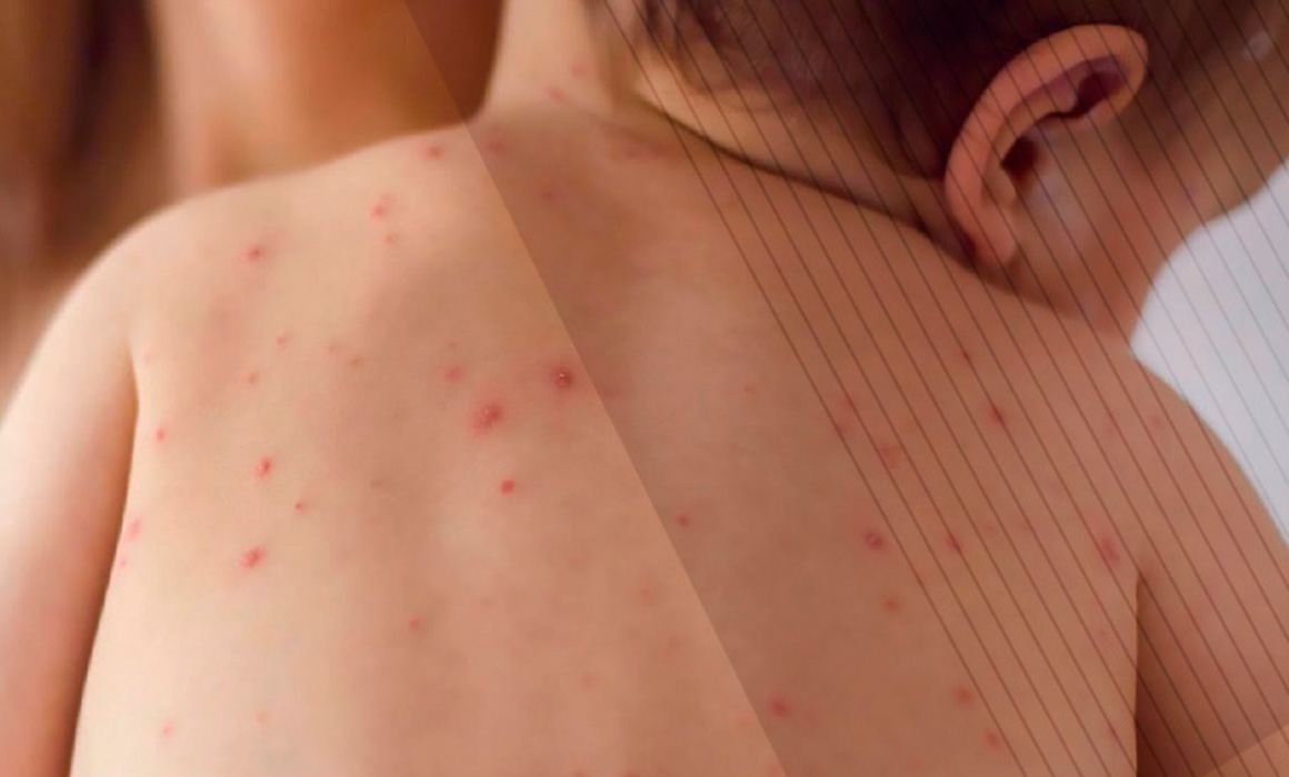 Lee más sobre el artículo Registra Ssa 23 muertes por brote de sarampión