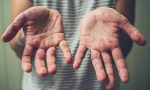 Lee más sobre el artículo Incrementa a 7 el número de casos de sarampión en Querétaro