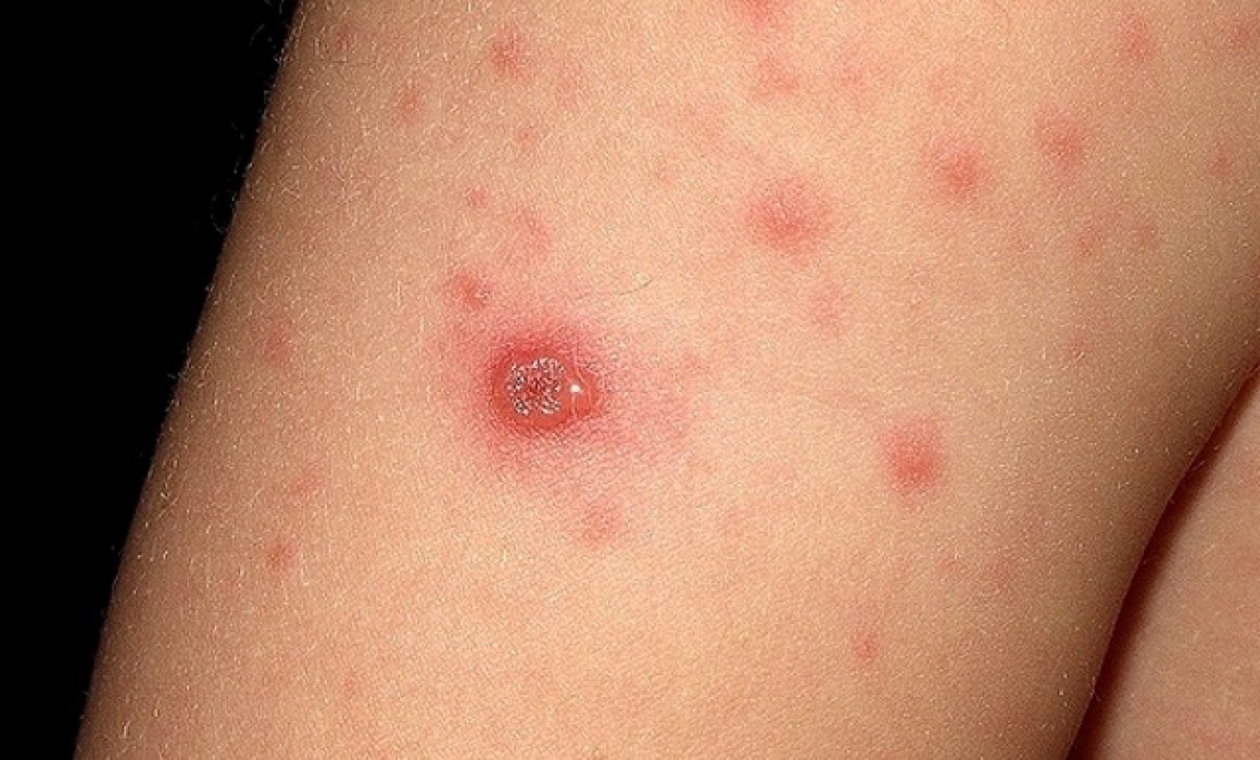 Lee más sobre el artículo Llaman a completar esquemas de vacunación para prevenir sarampión