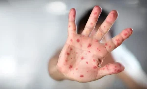 Lee más sobre el artículo Confirman 3 nuevos casos de sarampión en Querétaro; suman 37 en 2026.